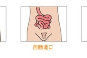 造口袋是什么
:疫情下，造口袋每日更换有多重要？