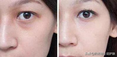 黑眼圈的图片
:怎么救特别严重的黑眼圈？