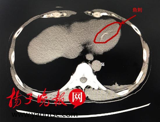抖鱼漫画
:吃鱼卡到刺了怎么办？