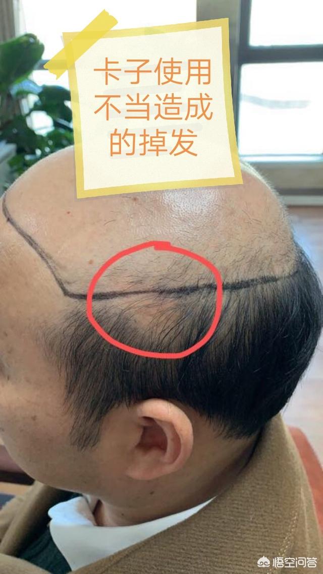 假发片怎么戴
:假发怎么戴？