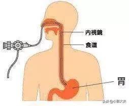 做胃镜疼么
:胃镜痛苦吗？做胃镜前要做些什么准备？